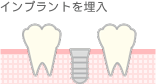 インプラントを埋入